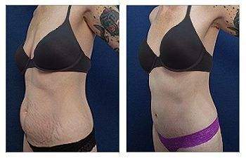 Tummy Tuck + Breast Surgery — #SS063 Tummy Tuck + Breast Surgery — #SS063