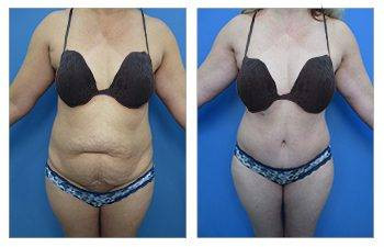Tummy Tuck — #SS342 Tummy Tuck — #SS342