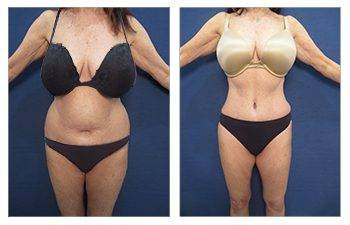 Tummy Tuck — #SS175 Tummy Tuck — #SS175