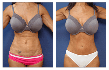 Tummy Tuck — #SS279 Tummy Tuck — #SS279