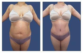 Tummy Tuck — #SS176 Tummy Tuck — #SS176