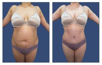 Tummy Tuck — #SS176 Tummy Tuck — #SS176