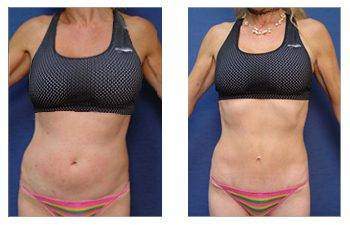 Mini Tummy Tuck — #SS069 Mini Tummy Tuck — #SS069