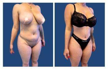 Do I Need a Garment After Tummy Tuck Surgery?