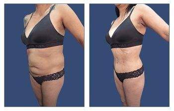 Tummy Tuck — #SS065 Tummy Tuck — #SS065