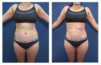 Tummy Tuck — #SS052 Tummy Tuck — #SS052