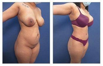 Tummy Tuck After C Section
