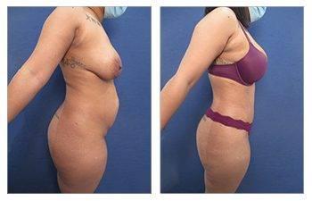 Tummy Tuck After C Section