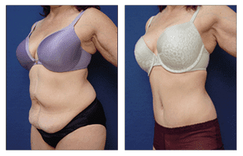 tummy tuck patient 31 front left view tummy tuck patient 31 front left view