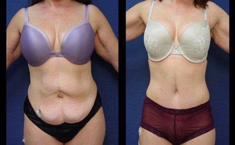 tummy tuck patient 31 front tummy tuck patient 31 front