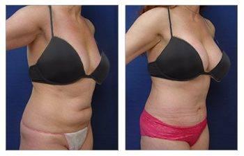 VASER High Definition Liposuction before and after. VASER High Definition Liposuction before and after.