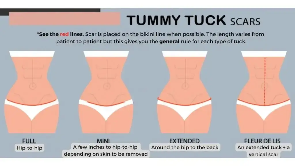 Tummy tuck scars infographic. Tummy tuck scars infographic.