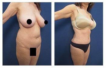 GMommy Tummy Tuck GMommy Tummy Tuck