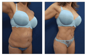 Tummy Tuck Muscle Repair Tummy Tuck Muscle Repair