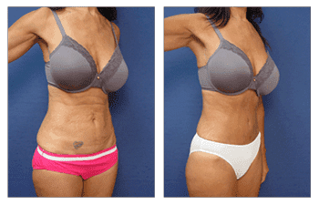 tummy tuck patient 48 front left view tummy tuck patient 48 front left view