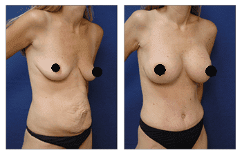 Best Tummy Tuck Best Tummy Tuck