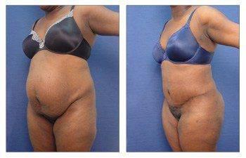 tummy tuck or body contouring procedure Los Angeles tummy tuck or body contouring procedure Los Angeles
