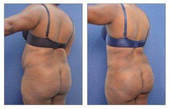 Tummy Tuck With 360 Body Contouring Tummy Tuck With 360 Body Contouring