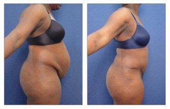 full tummy tuck Long Beach full tummy tuck Long Beach