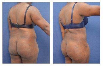 tummy tuck with muscle plication and body contouring San Diego tummy tuck with muscle plication and body contouring San Diego