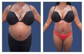 Tummy Tuck With 360 Body Contouring Tummy Tuck With 360 Body Contouring