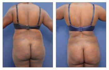 Tummy Tuck With 360 Body Contouring Tummy Tuck With 360 Body Contouring