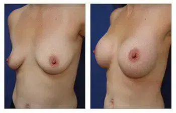 A woman's breast before and after undergoing breast augmentation surgery. A woman's breast before and after undergoing breast augmentation surgery.