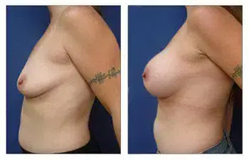 A woman's breast before and after undergoing breast augmentation surgery. A woman's breast before and after undergoing breast augmentation surgery.