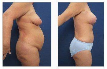 breast lift patient 1 right view breast lift patient 1 right view