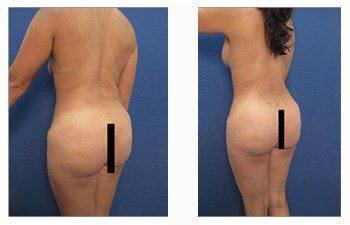 Tummy tuck and HD Liposuction before and after.
