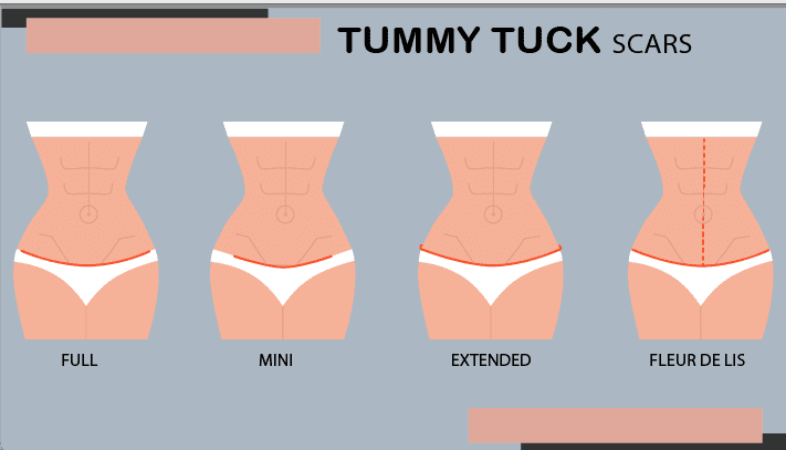Understanding the Mini Tummy Tuck Understanding the Mini Tummy Tuck