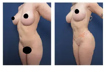 Most Expensive Liposuction in the World Most Expensive Liposuction in the World