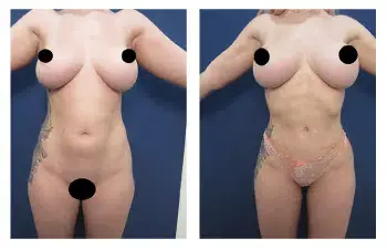 Most Expensive Liposuction in the World Most Expensive Liposuction in the World