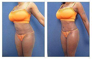 HD Liposuction — #SS022 HD Liposuction — #SS022