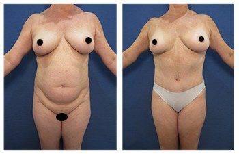 Thigh Lipo Thigh Lipo