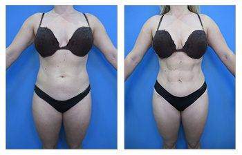 Awake Liposuction — #SS012 Awake Liposuction — #SS012