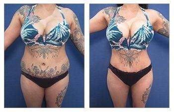 HD Liposuction — #SS116 HD Liposuction — #SS116