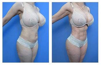 HD Liposuction + Fat Transfer — #SS004 HD Liposuction + Fat Transfer — #SS004