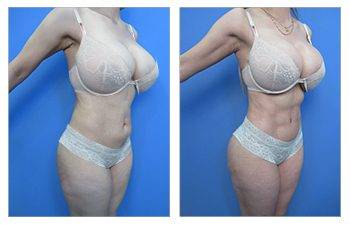 VASER Liposuction tummy tuck before and after. VASER Liposuction tummy tuck before and after.
