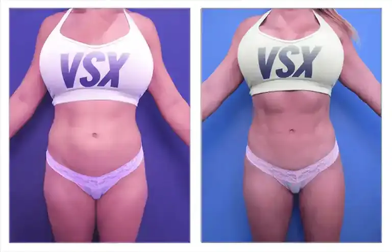 A woman before and after 360 lipo in a bikini. A woman before and after 360 lipo in a bikini.