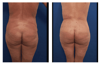 Vaser Lipo Pros and Cons — patient photo Vaser Lipo Pros and Cons — patient photo