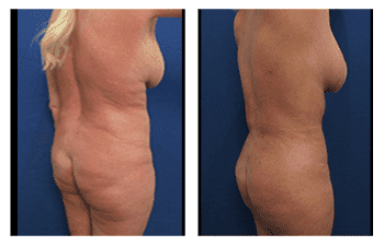 Vaser Lipo Pros and Cons — patient photo Vaser Lipo Pros and Cons — patient photo