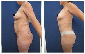 body sculpting Dana Point