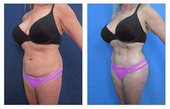 HD Liposuction — #SS084 HD Liposuction — #SS084