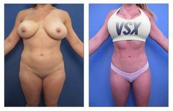 A woman's breast before and after surgery for breast herniation. A woman's breast before and after surgery for breast herniation.