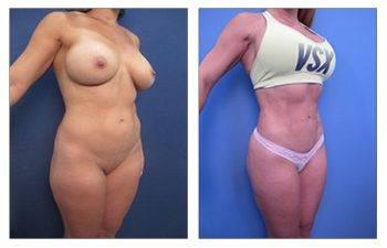 Discover the transformative effects of a mini tummy tuck before and after the procedure. Discover the transformative effects of a mini tummy tuck before and after the procedure.
