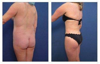 Lateral thigh tuck Lateral thigh tuck