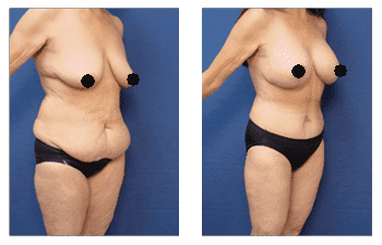 What is The Difference Between Lipedema and Lymphedema? What is The Difference Between Lipedema and Lymphedema?