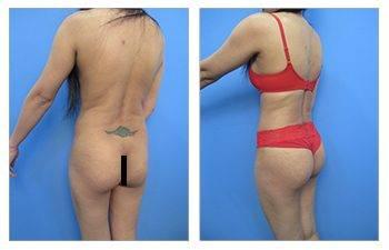 How to avoid skin redundancy following high definition body contouring — patient photo How to avoid skin redundancy following high definition body contouring — patient photo