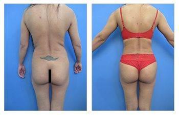 What Is The Skinny Brazilian Buttock Lift — patient photo What Is The Skinny Brazilian Buttock Lift — patient photo
